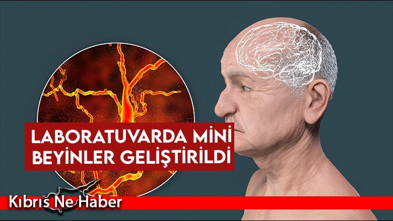 Cambridge Üniversitesi’nden demans ve felce karşı önemli adım...