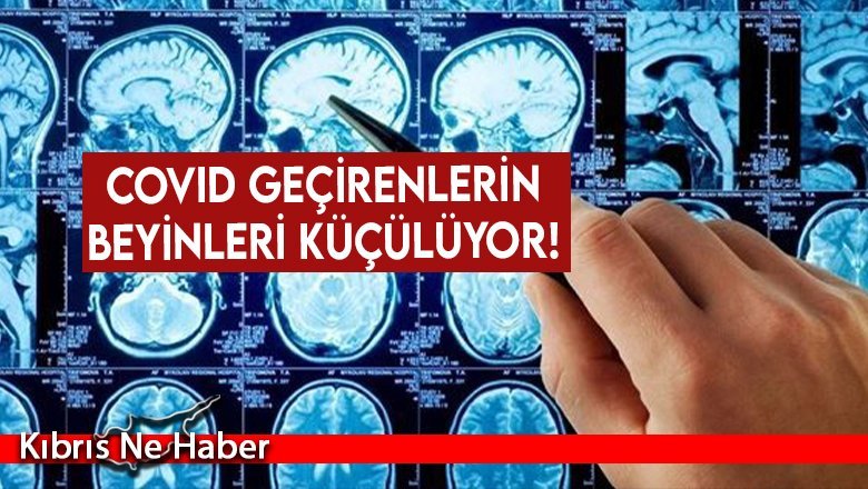 Covid geçirenlerin beyinleri küçülüyor!