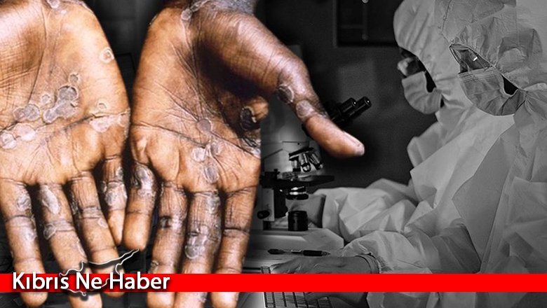DSÖ: Dünyada maymun çiçeği vakaları 780'e yükseldi