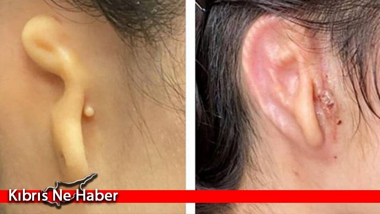 İnsan hücresinden üç boyutlu yazıcıyla kulak yaptılar