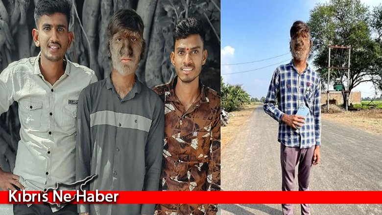 Sadece 50 kişide görülen sendrom kurt adama çevirdi! Yaşını duyan şaştı kaldı