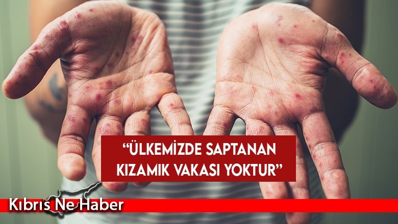 Dinçyürek: Ülkemizde saptanan kızamık vakası yoktur