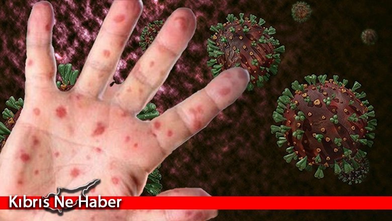 Tabipler Birliği, M-Çiçeği önlemleri üzerine bilgi talep etti