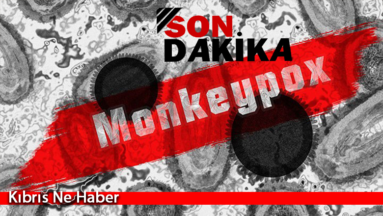 Kıbrıs’ın güneyinde ilk maymun çiçeği vakası…